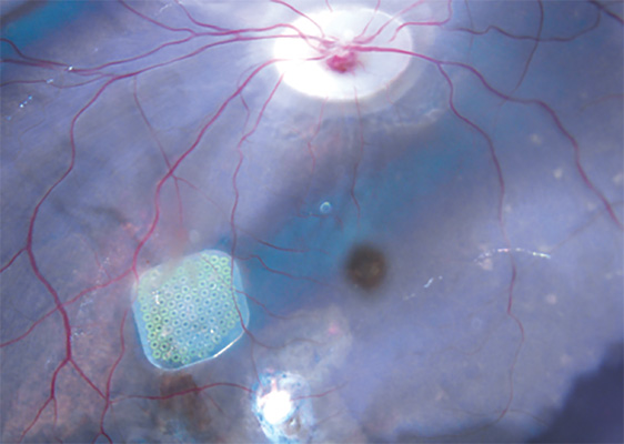 prothese-retinienne-institut-de-la-vision-guidevue