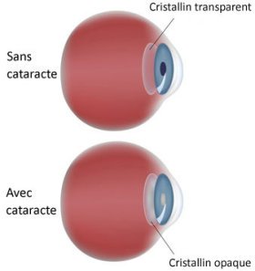 schéma opération cataracte