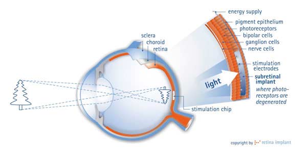 oeil rétinite pigmentaire implant rétinien 