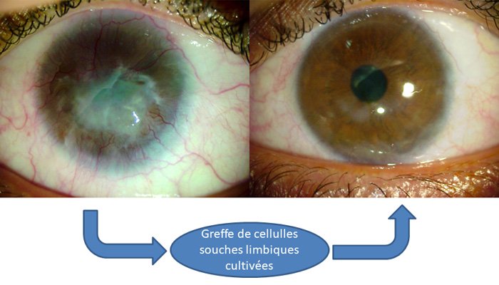 pathologies-cornee-partie-2-guide-vue.fr