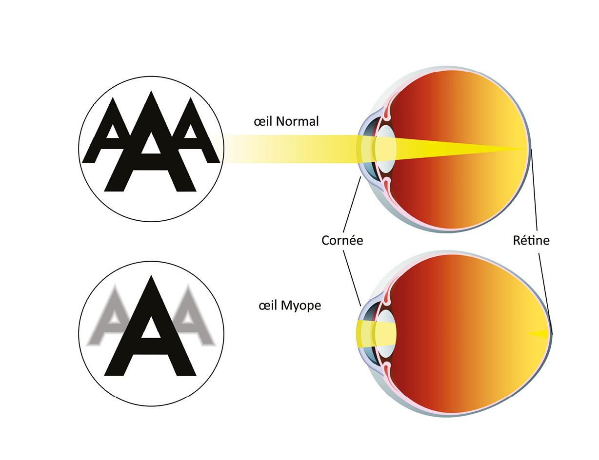 schéma Myope myopie Guide-Vue