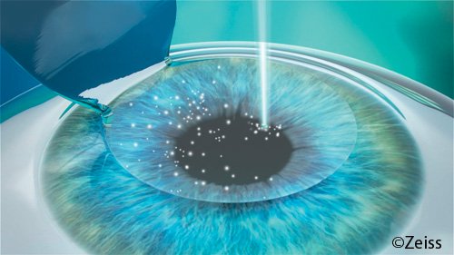 LASIK, laser excimer, laser des yeux