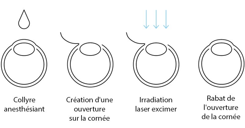 oprétaion laser des yeux myopie