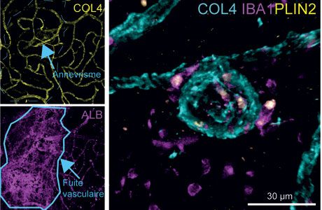 Colocation des macrophages modifiés et des zones de microanévrismes - Institut de la Vision © DR