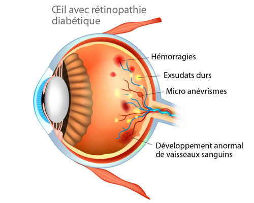 oeil avec rétinopathie diabétique