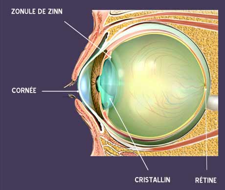 schéma oeil cataracte cristallin Guide-Vue