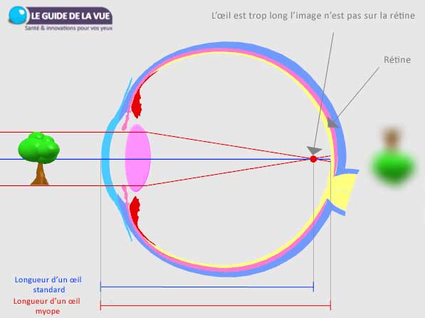 oeil myope