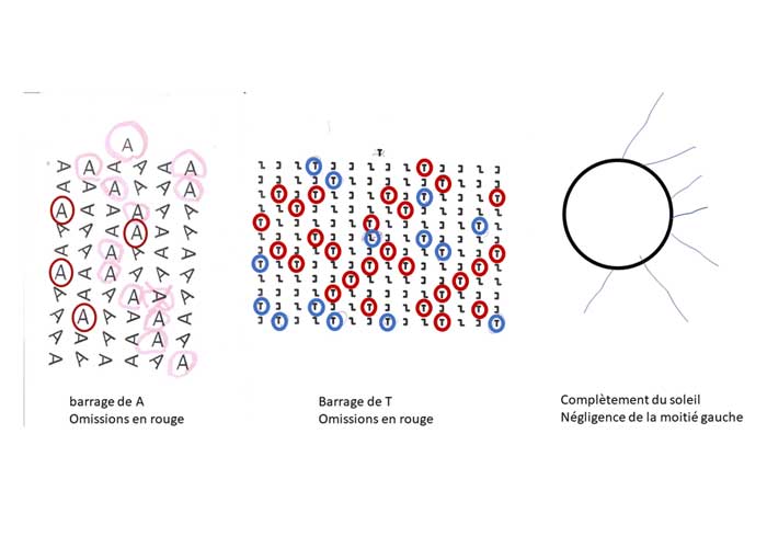 Production troubles neurovisuels