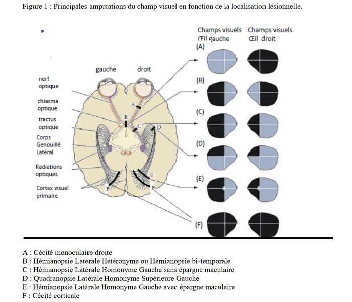 troubles neurovisuel champ visuel